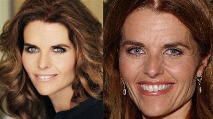 Doctors Have Claimed That Maria Shriver has Had A Facelift